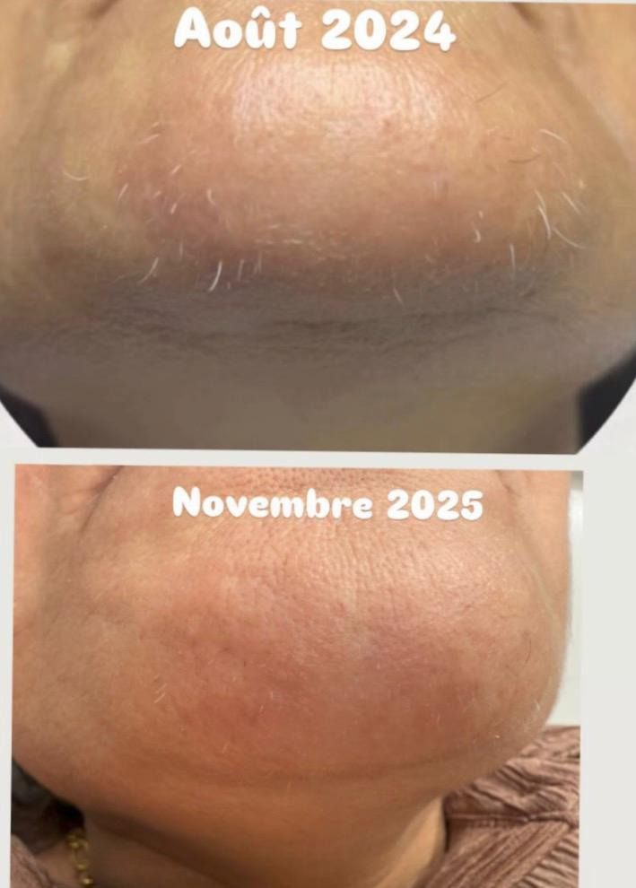 Suivi menton — août 2024 et novembre 2025